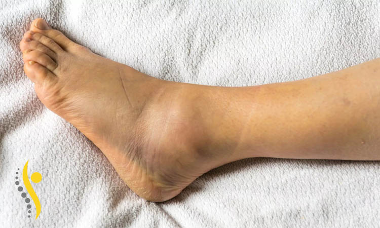 فیزیوتراپی پیچ خوردگی مچ پا