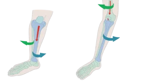 آسیب به تاندون و رباط زانو