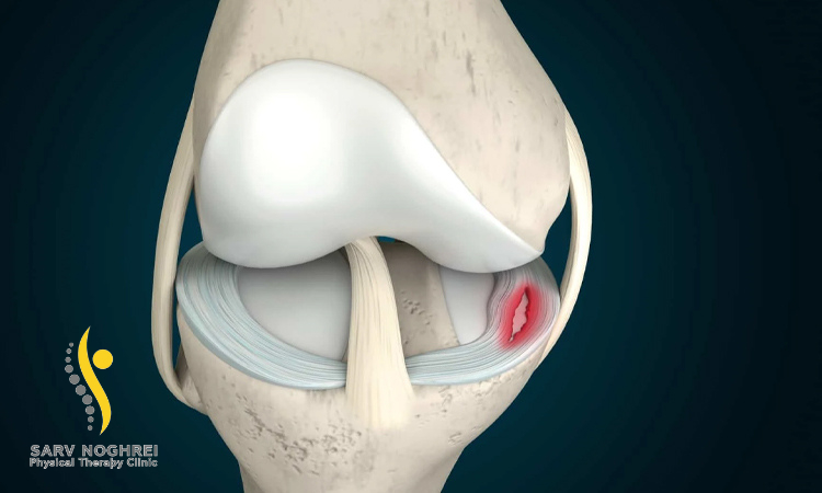 آسیب منیسک زانو چگونه ایجاد می شود؟