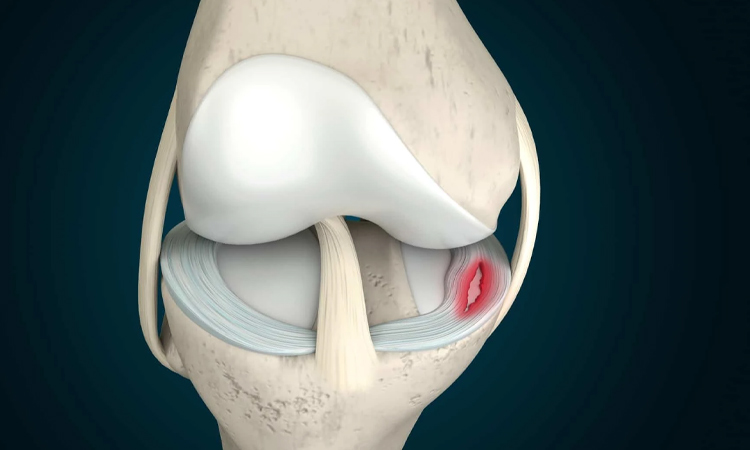 آسیب منیسک زانو چگونه ایجاد می شود؟
