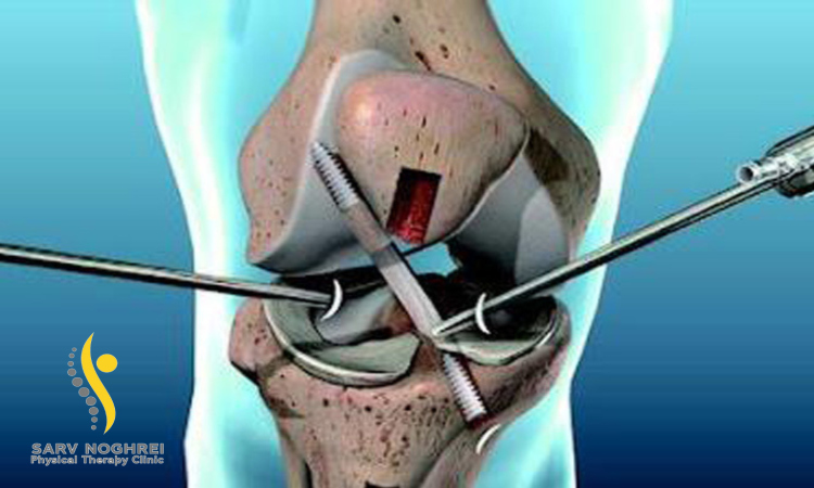 انواع رباط های صلیبی در زانو