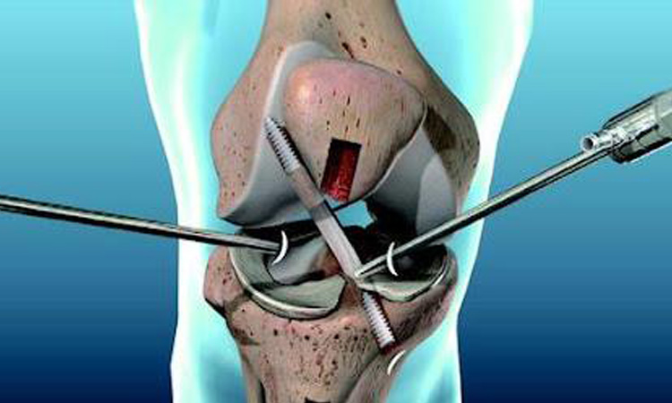 انواع رباط های صلیبی در زانو