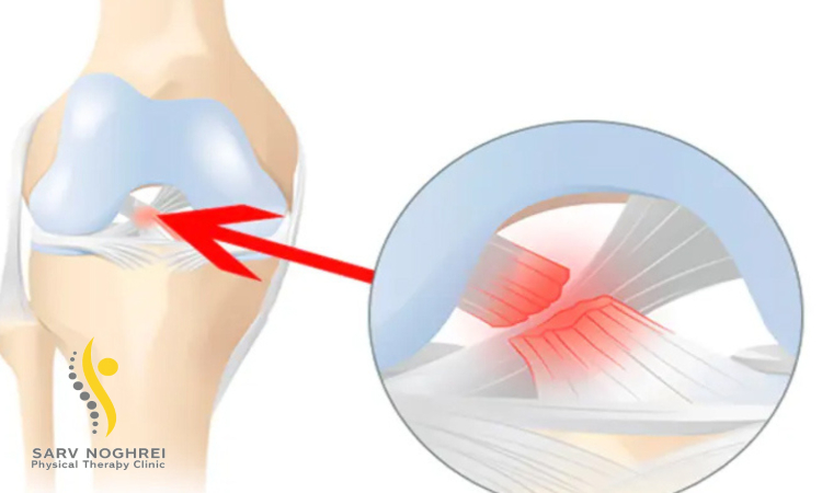 علائم و نشانه های آسیب رباط صلیبی