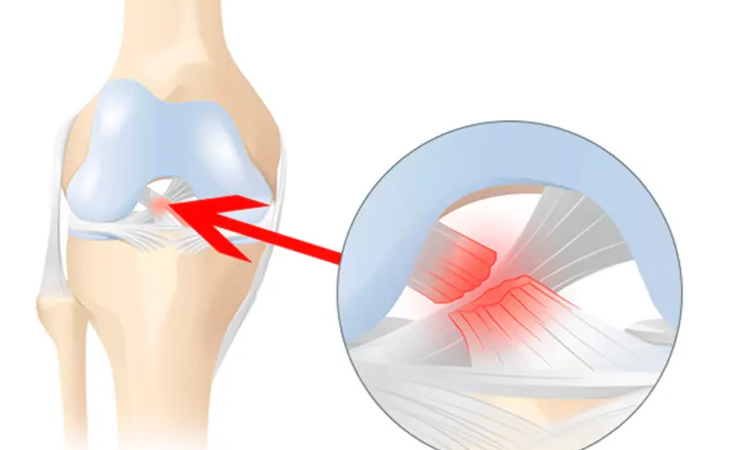 علائم و نشانه های آسیب رباط صلیبی