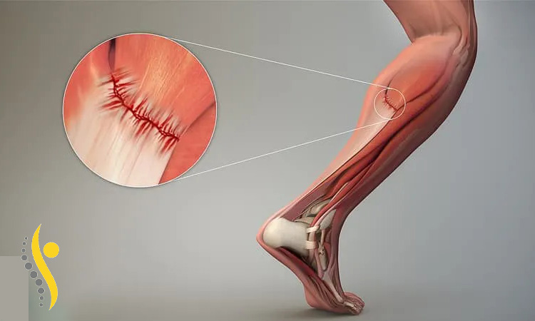 دلایل کشیدگی تاندون