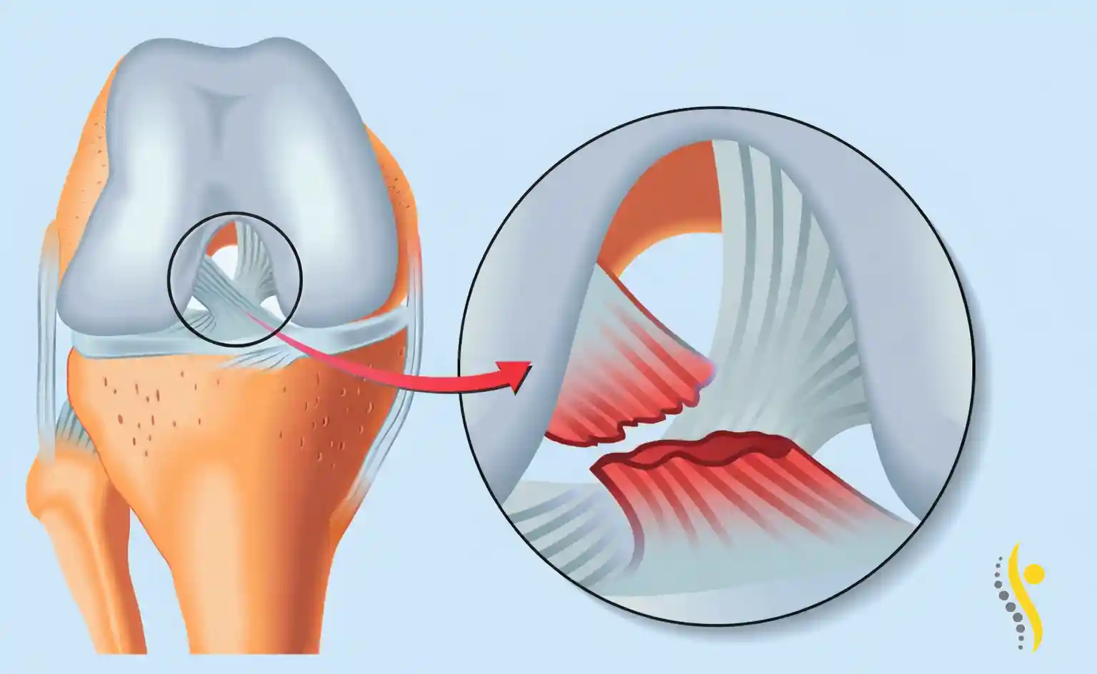 علائم پارگی رباط صلیبی