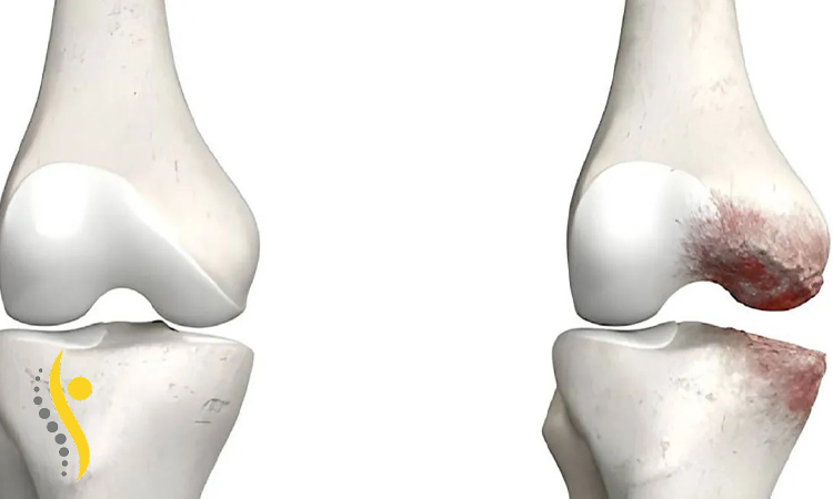 علائم استئوکندریت