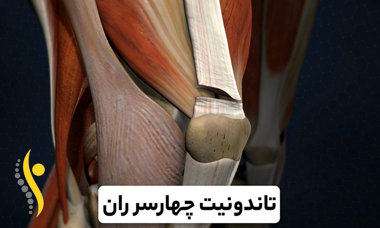 سندرم درد کشککی ران