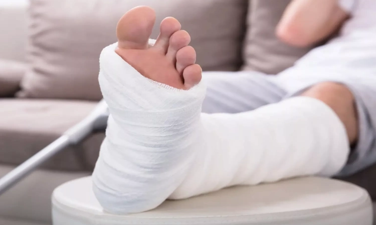 علائم کشیدگی و تاندون